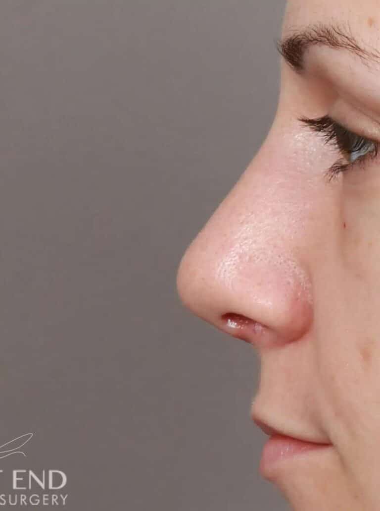 After Image: Rhinoplasty & Septoplasty (1 Month Post-op) - left-side