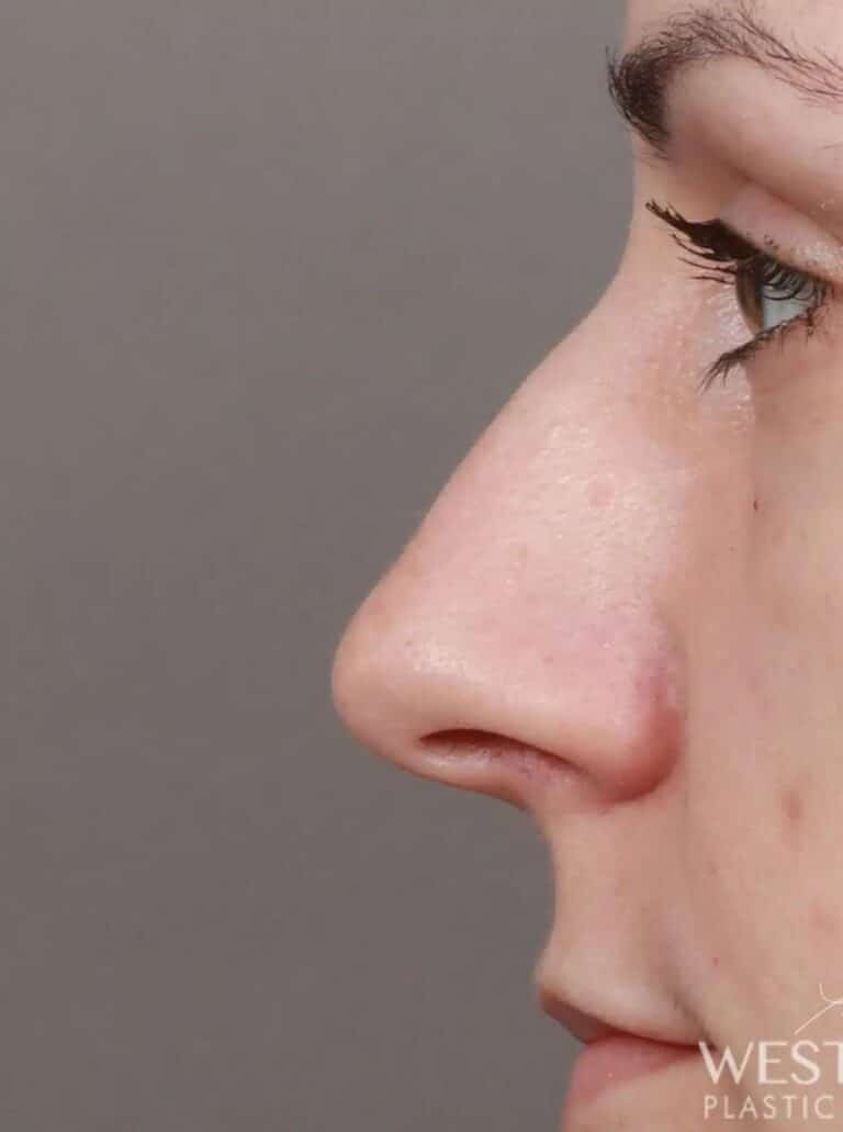 Before Image: Rhinoplasty & Septoplasty (1 Month Post-op) - left-side