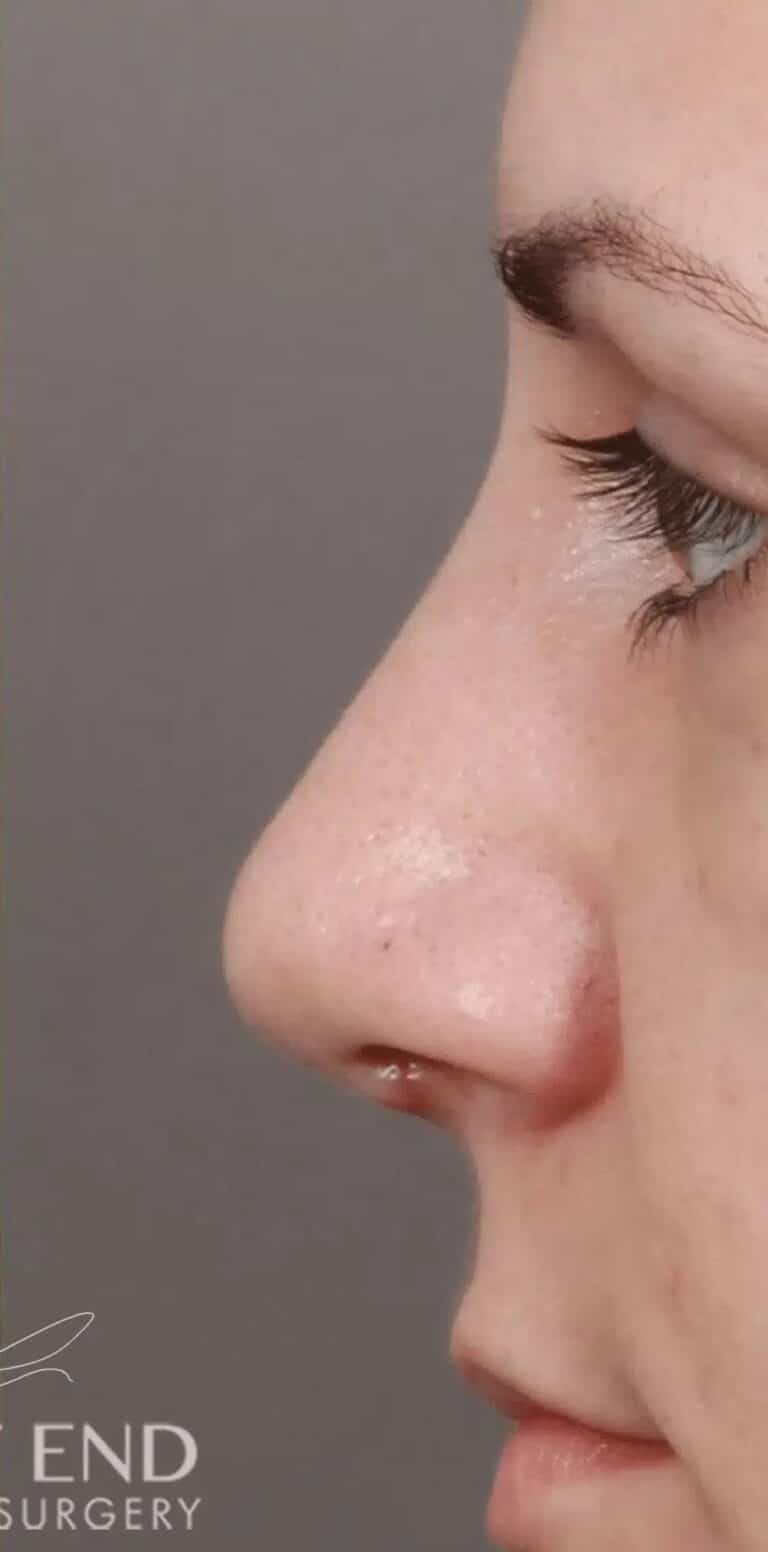 After Image: Rhinoplasty & Septoplasty (1 Month Post-op) - left-side