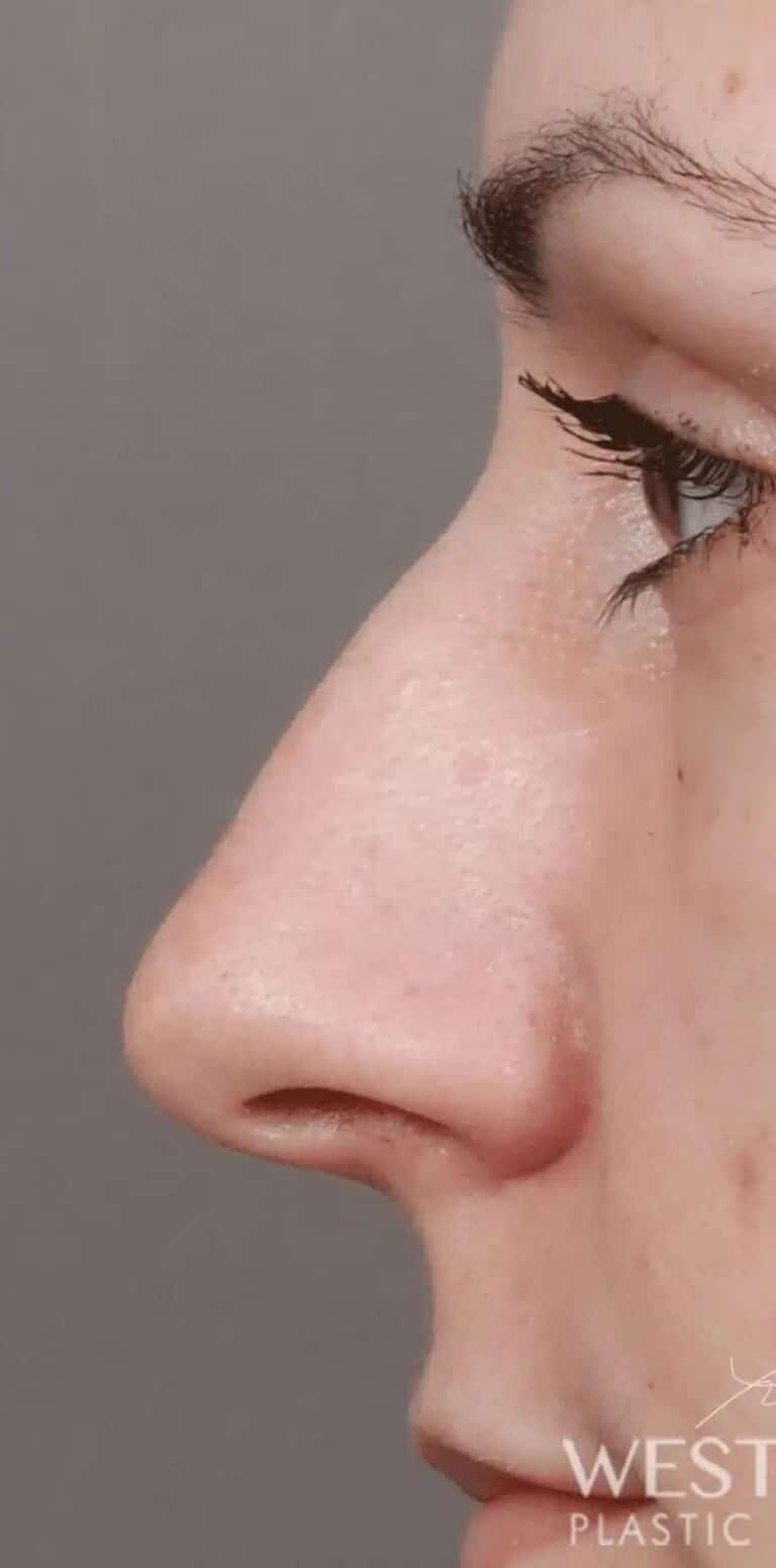 Before Image: Rhinoplasty & Septoplasty (1 Month Post-op) - left-side