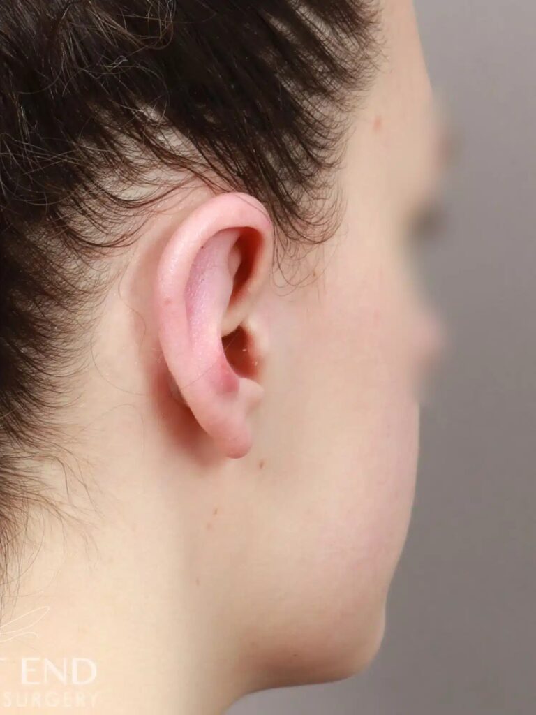 After Image: Otoplasty (2 Weeks Post-op) - right-back-oblique