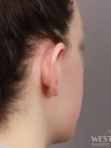 Before Image: Otoplasty (2 Weeks Post-op)