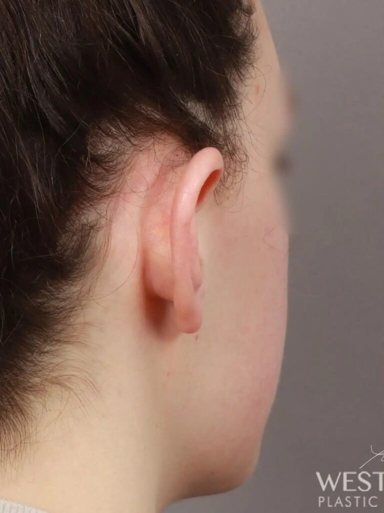 Before Image: Otoplasty (2 Weeks Post-op) - right-back-oblique