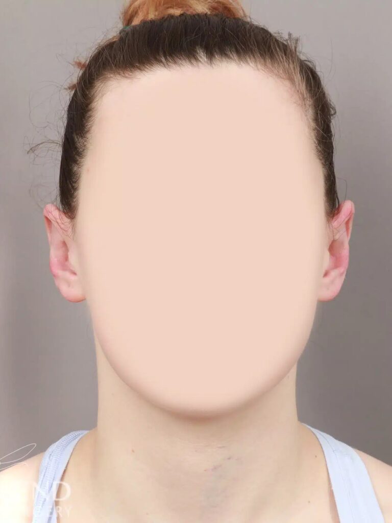 After Image: Otoplasty (2 Weeks Post-op) - front