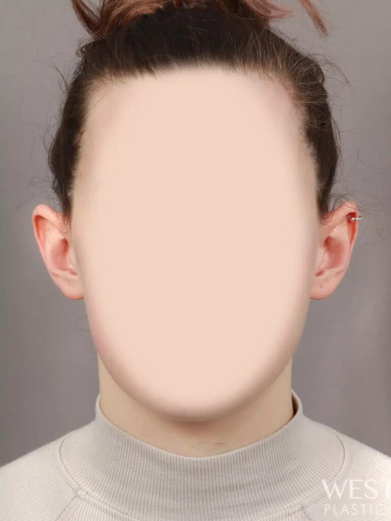 Before Image: Otoplasty (2 Weeks Post-op) - front