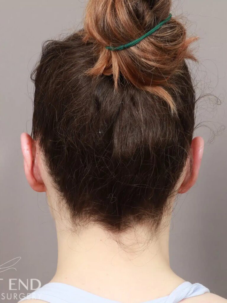 After Image: Otoplasty (2 Weeks Post-op) - back