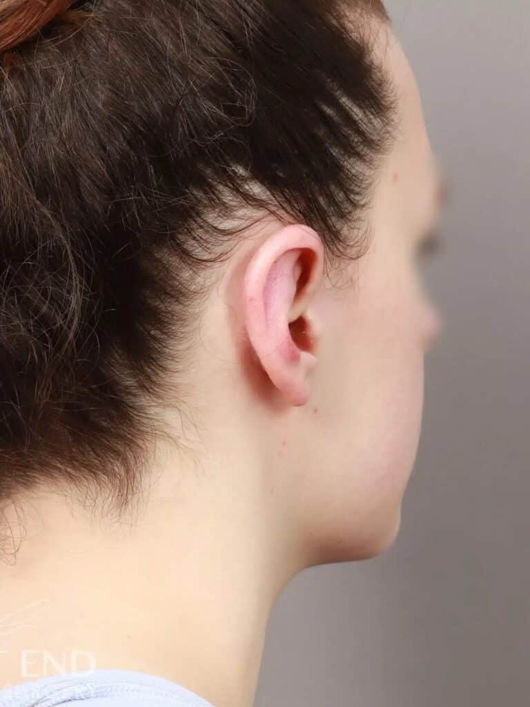 After Image: Otoplasty (2 Weeks Post-op) - right-back-oblique