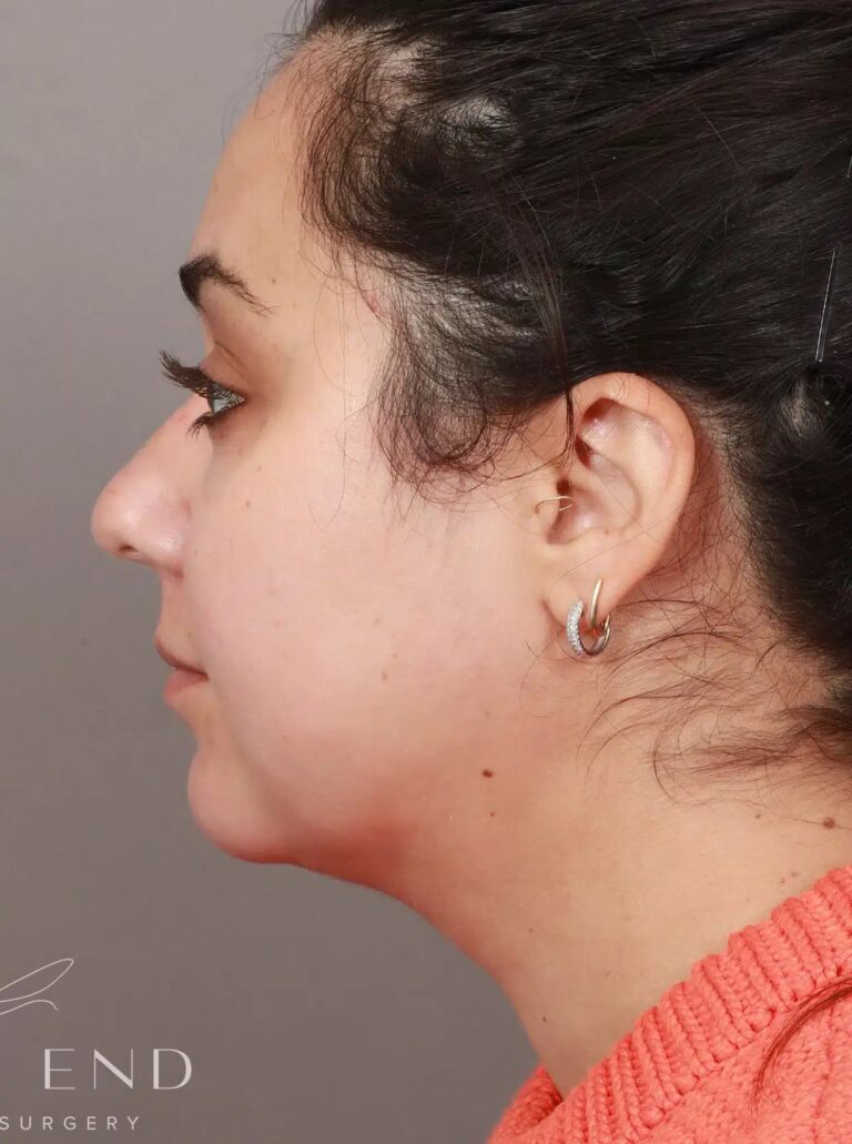 After Image: Liposuction & Renuvion Skin Tightening (2 Weeks Post-op) - left-side