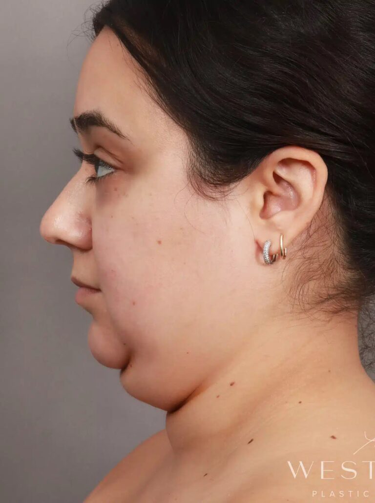 Before Image: Liposuction & Renuvion Skin Tightening (2 Weeks Post-op) - left-side