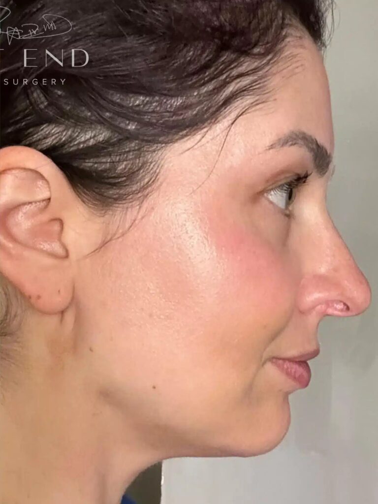 After Image: Liposuction & Renuvion Skin Tightening (9 Days Post-op) - right-side