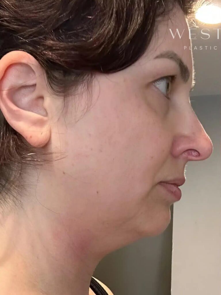 Before Image: Liposuction & Renuvion Skin Tightening (9 Days Post-op) - right-side