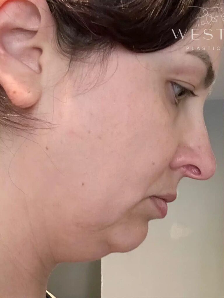 Before Image: Liposuction & Renuvion Skin Tightening (9 Days Post-op) - right-front-oblique
