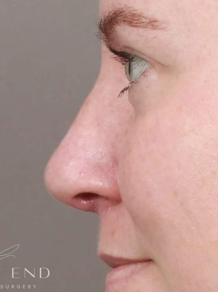 After Image: Rhinoplasty & Septoplasty with Clarifix (3 months Post-op) - left-side
