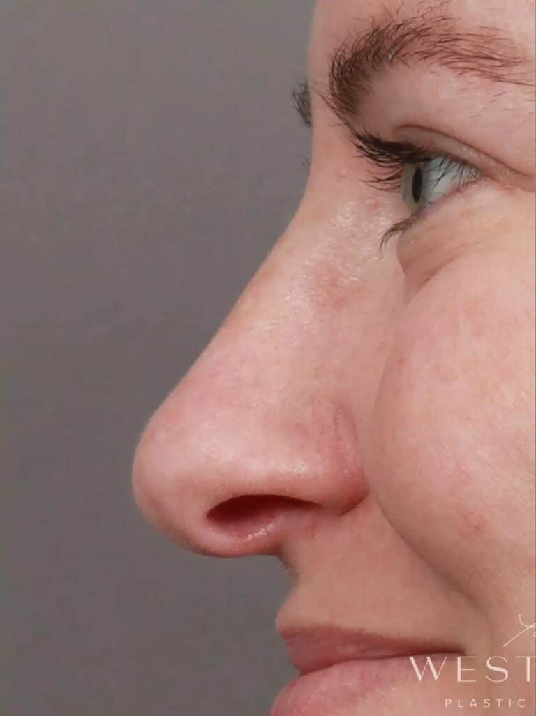Before Image: Rhinoplasty & Septoplasty with Clarifix (3 months Post-op) - left-side