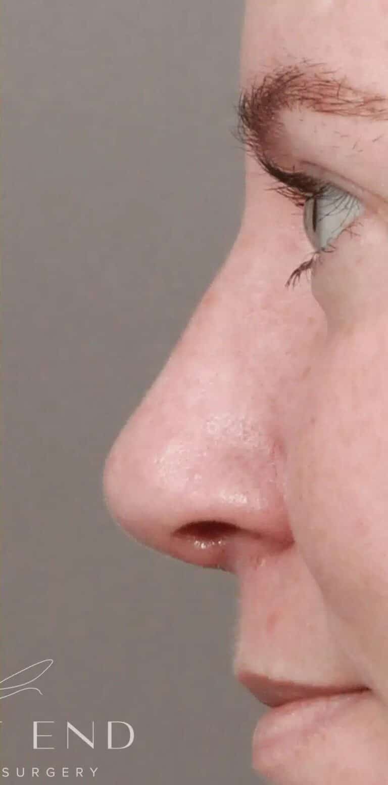 Before Image: Rhinoplasty & Septoplasty with Clarifix (3 months Post-op) - left-side