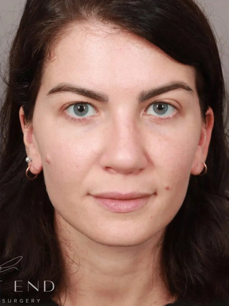 After Image: Rhinoplasty & Septoplasty (4.5 Months Post-op) - front