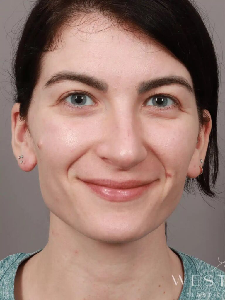 Before Image: Rhinoplasty & Septoplasty (4.5 Months Post-op) - front