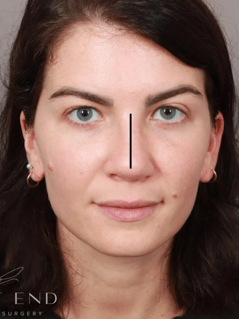 After Image: Rhinoplasty & Septoplasty (4.5 Months Post-op) - front
