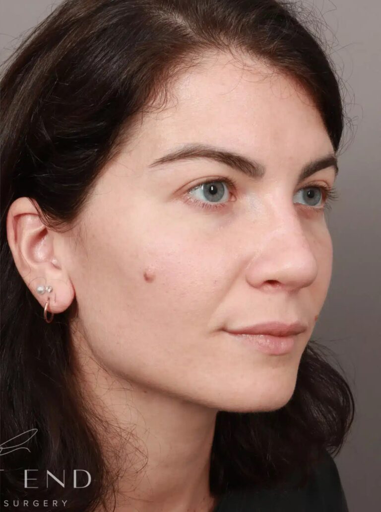 After Image: Rhinoplasty & Septoplasty (4.5 Months Post-op) - right-front-oblique