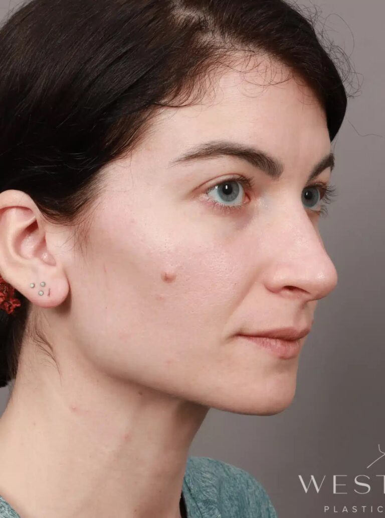 Before Image: Rhinoplasty & Septoplasty (4.5 Months Post-op) - right-front-oblique