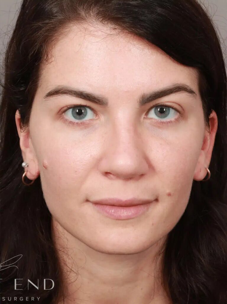 After Image: Rhinoplasty & Septoplasty (4.5 Months Post-op) - front
