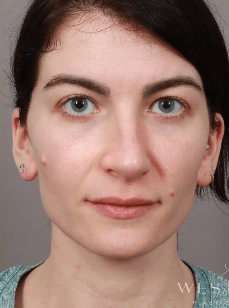 Before Image: Rhinoplasty & Septoplasty (4.5 Months Post-op) - front