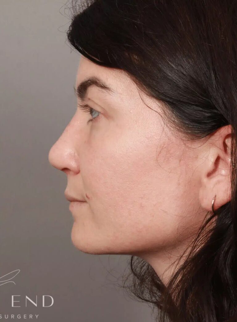 After Image: Rhinoplasty & Septoplasty (4.5 Months Post-op) - left-side