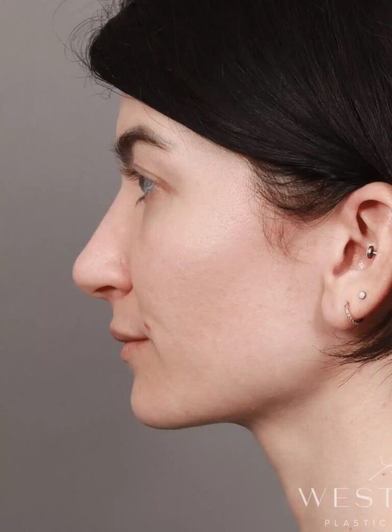 Before Image: Rhinoplasty & Septoplasty (4.5 Months Post-op) - left-side