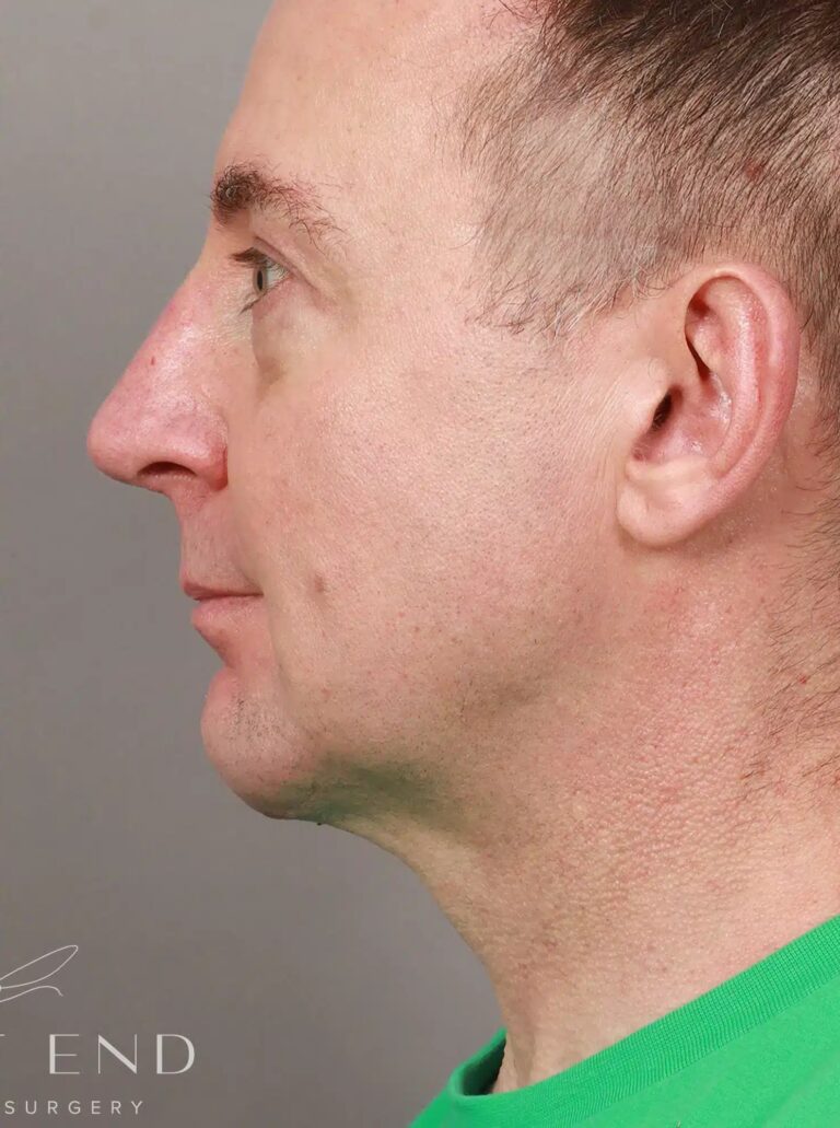 After Image: Rhinoplasty, Chin Implant, Eyelid Lift, and Brow Lift (4 Months Post-Op) - left-side
