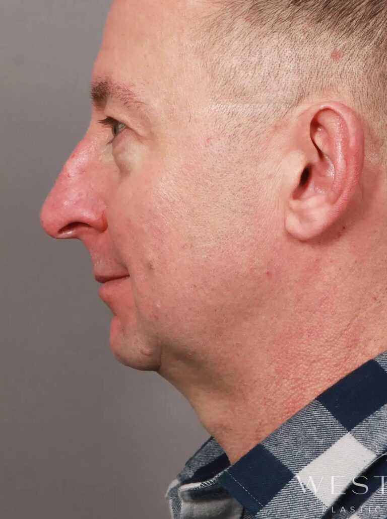 Before Image: Rhinoplasty, Chin Implant, Eyelid Lift, and Brow Lift (4 Months Post-Op) - left-side