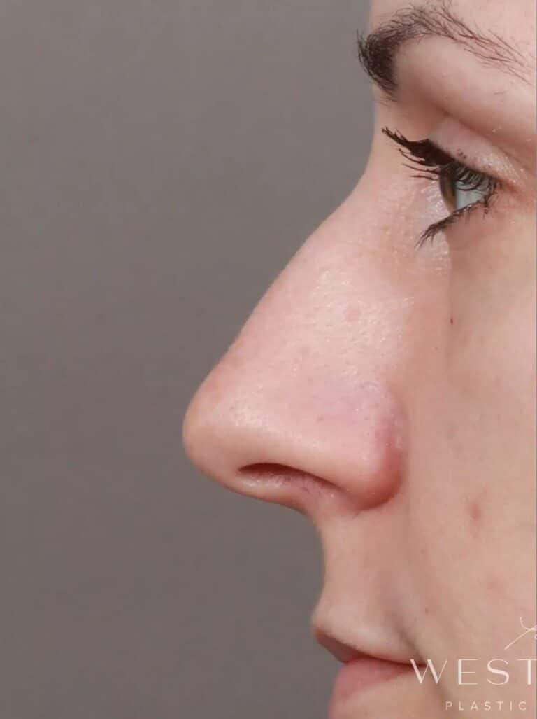 Before Image: Rhinoplasty & Septoplasty (3.5 Months Post-op) - left-side