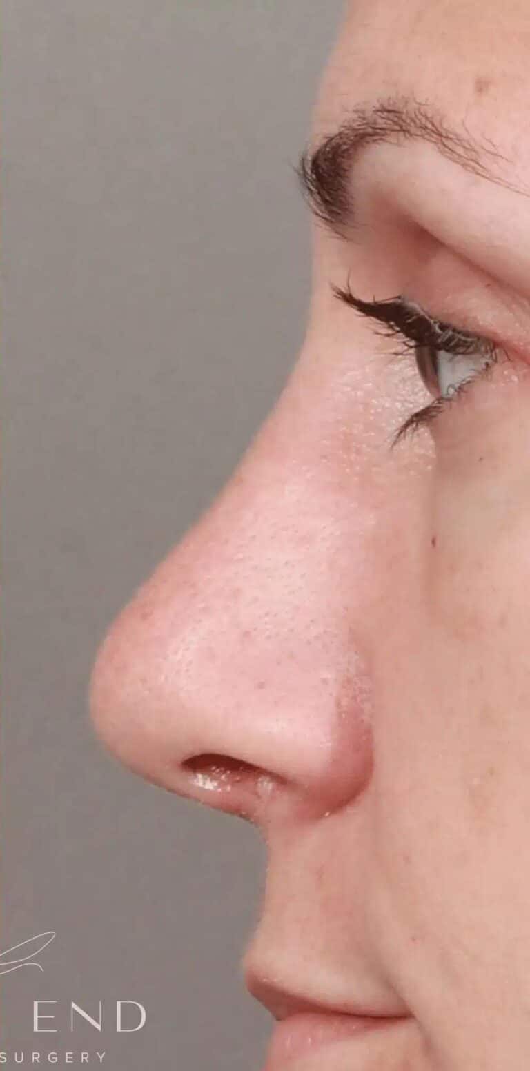 After Image: Rhinoplasty & Septoplasty (3.5 Months Post-op) - left-side