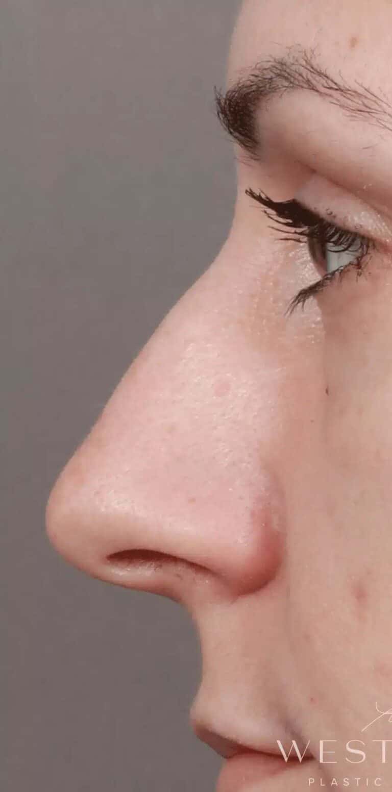Before Image: Rhinoplasty & Septoplasty (3.5 Months Post-op) - left-side