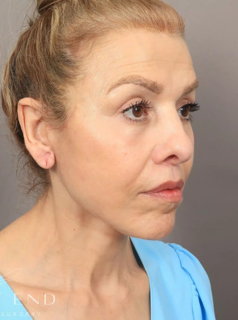 After Image: Deep Plane Facelift and Neck Lift, Brow Lift, Blepharoplasty (Eyelid Lift), Lip Lift, Fat Grafting, and CO2 Resurfacing. - right-front-oblique