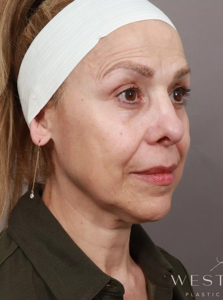 Before Image: Deep Plane Facelift and Neck Lift, Brow Lift, Blepharoplasty (Eyelid Lift), Lip Lift, Fat Grafting, and CO2 Resurfacing. - right-front-oblique