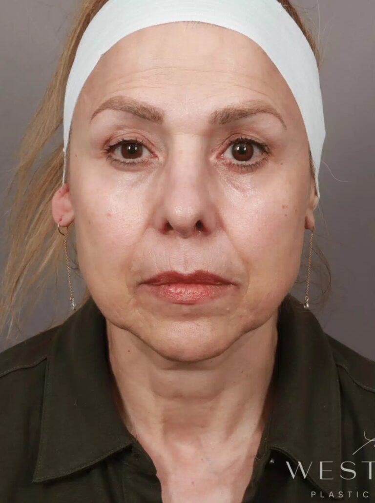 Before Image: Deep Plane Facelift and Neck Lift, Brow Lift, Blepharoplasty (Eyelid Lift), Lip Lift, Fat Grafting, and CO2 Resurfacing. - front