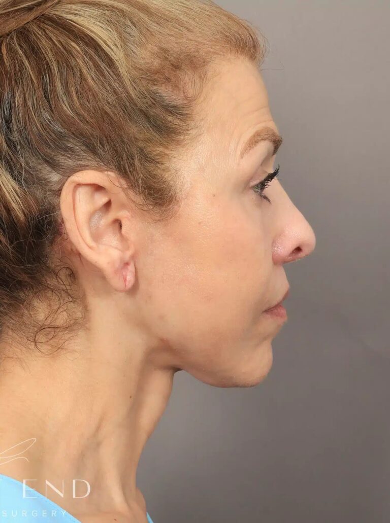 After Image: Deep Plane Facelift and Neck Lift, Brow Lift, Blepharoplasty (Eyelid Lift), Lip Lift, Fat Grafting, and CO2 Resurfacing. - right-side