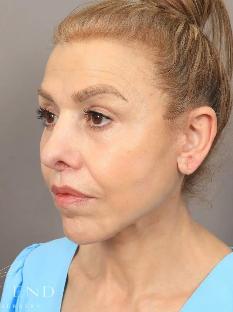 After Image: Deep Plane Facelift and Neck Lift, Brow Lift, Blepharoplasty (Eyelid Lift), Lip Lift, Fat Grafting, and CO2 Resurfacing. - left-front-oblique