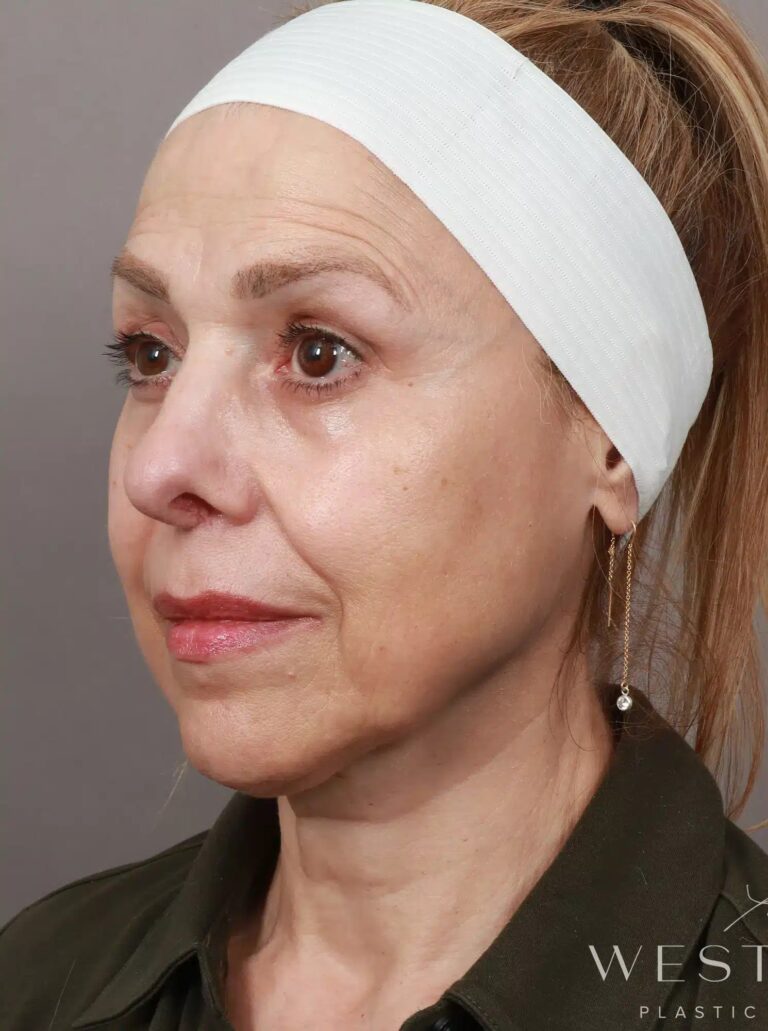 Before Image: Deep Plane Facelift and Neck Lift, Brow Lift, Blepharoplasty (Eyelid Lift), Lip Lift, Fat Grafting, and CO2 Resurfacing. - left-front-oblique