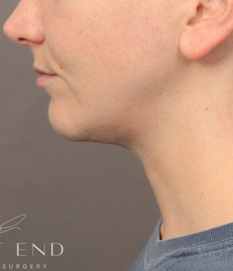 After Image: Chin Implant with Liposuction and Renuvion (1 Month Post-op) - left-side