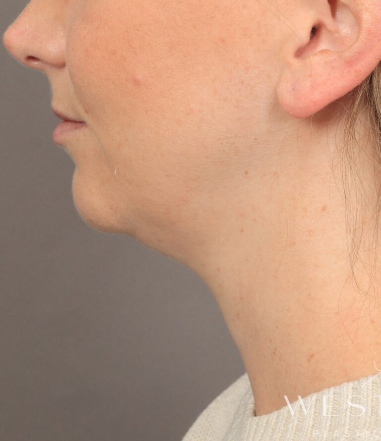 Before Image: Chin Implant with Liposuction and Renuvion (1 Month Post-op) - left-side