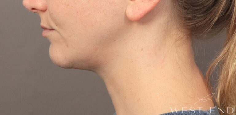 After Image: Chin Implant with Liposuction and Renuvion (1 Month Post-op) - left-side