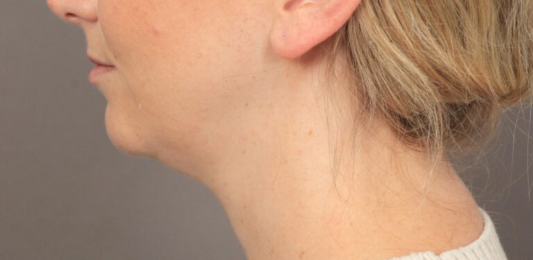 Before Image: Chin Implant with Liposuction and Renuvion (1 Month Post-op) - left-side
