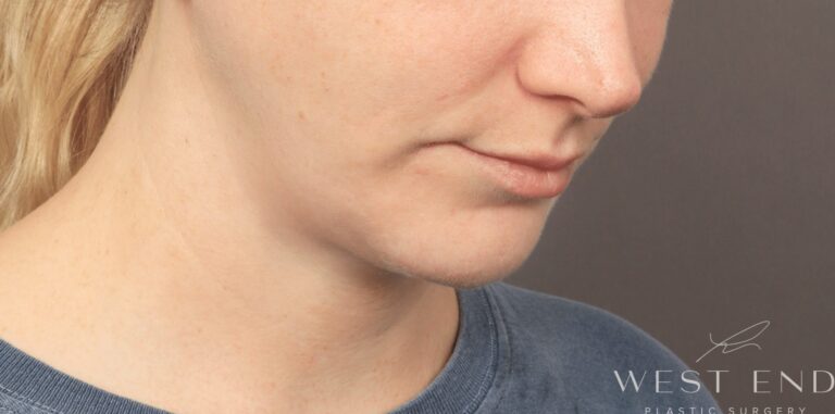 After Image: Chin Implant with Liposuction and Renuvion (1 Month Post-op) - right-front-oblique
