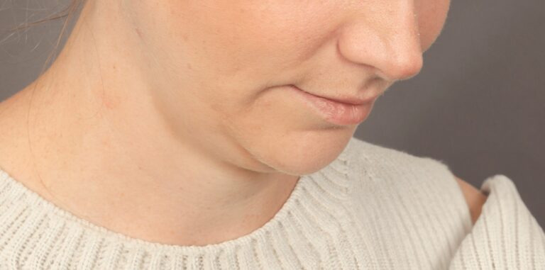 Before Image: Chin Implant with Liposuction and Renuvion (1 Month Post-op) - right-front-oblique