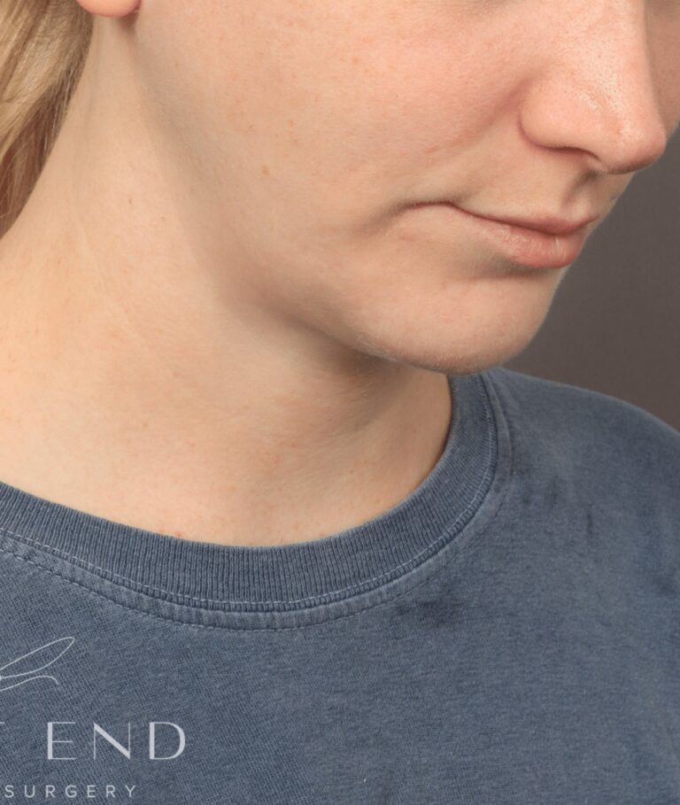 After Image: Chin Implant with Liposuction and Renuvion (1 Month Post-op) - right-front-oblique