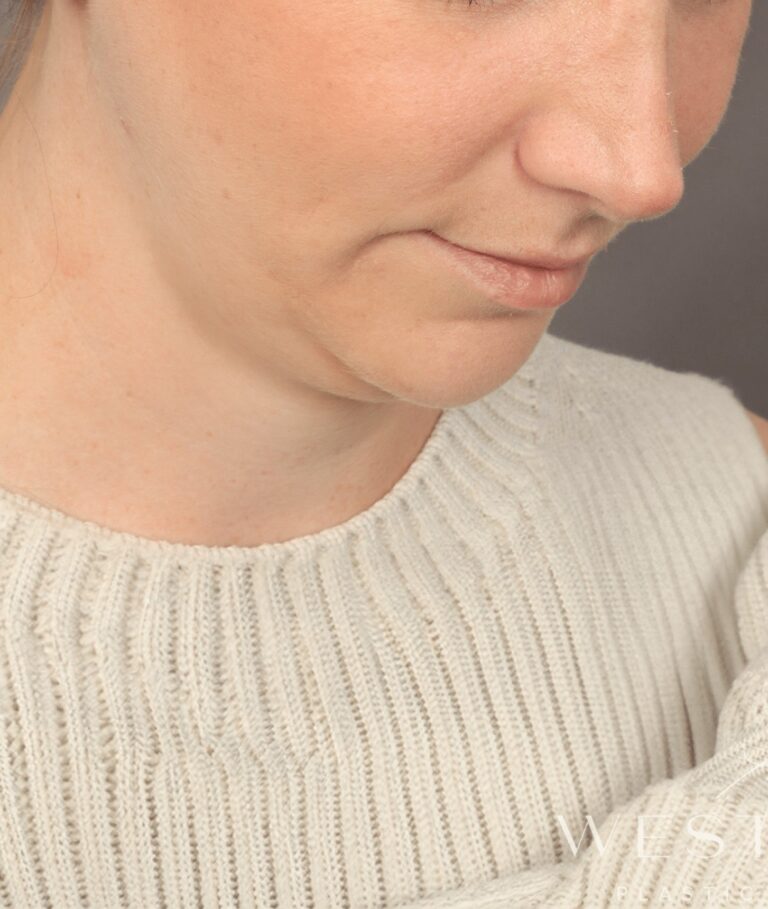 Before Image: Chin Implant with Liposuction and Renuvion (1 Month Post-op) - right-front-oblique