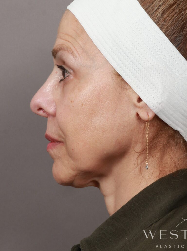 Before Image: Deep Plane Facelift and Neck Lift, Brow Lift, Blepharoplasty (Eyelid Lift), Lip Lift, Fat Grafting, and CO2 Resurfacing (7.5 Months Post-op) - left-side