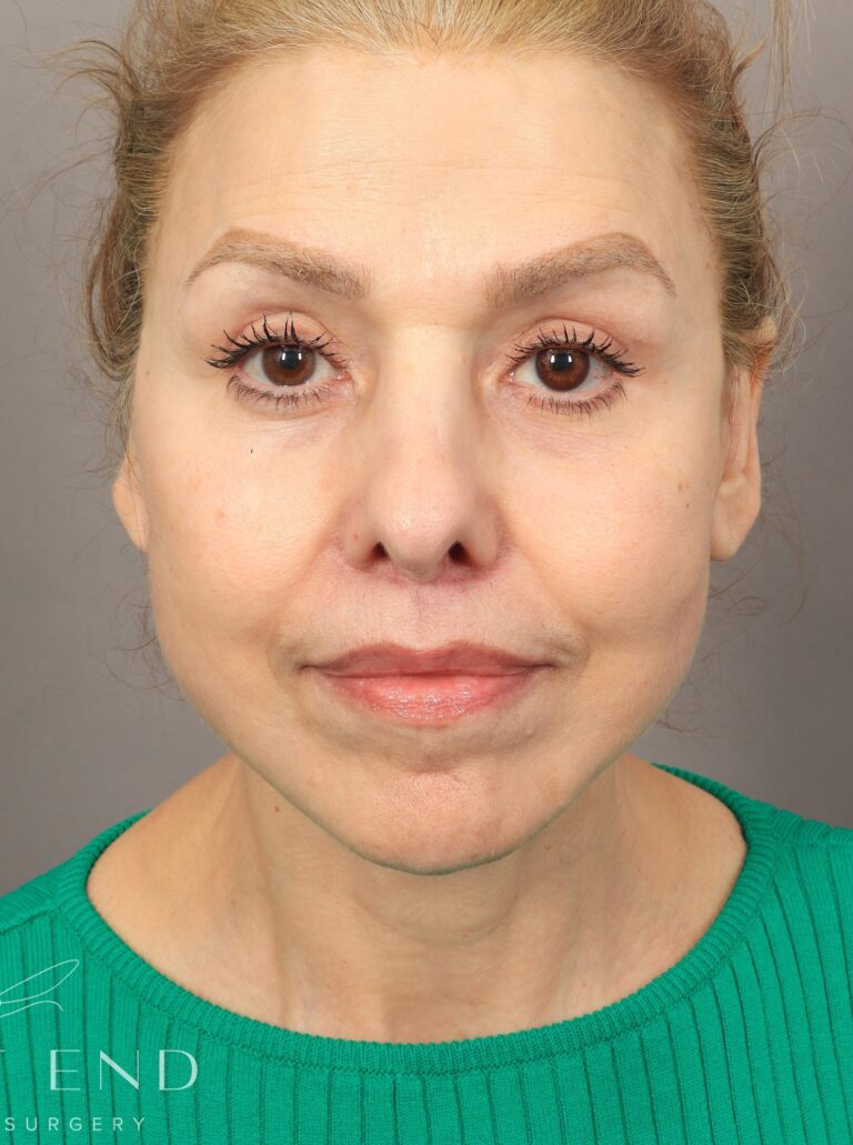 After Image: Deep Plane Facelift and Neck Lift, Brow Lift, Blepharoplasty (Eyelid Lift), Lip Lift, Fat Grafting, and CO2 Resurfacing (7.5 Months Post-op) - front