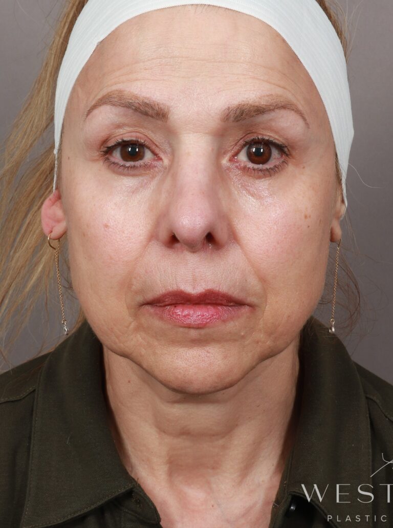 Before Image: Deep Plane Facelift and Neck Lift, Brow Lift, Blepharoplasty (Eyelid Lift), Lip Lift, Fat Grafting, and CO2 Resurfacing (7.5 Months Post-op) - front